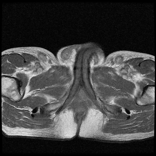 File:Necrotizing epididymo-orchitis with intra-testicular abscess (Radiopaedia 29397-29860 Axial T1 C+ 9).jpg