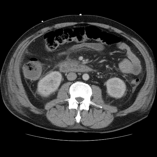 File:Necrotizing pancreatitis - acute necrotic collection maturing into walled-off pancreatic necrosis (Radiopaedia 9602-10249 A 10).jpg