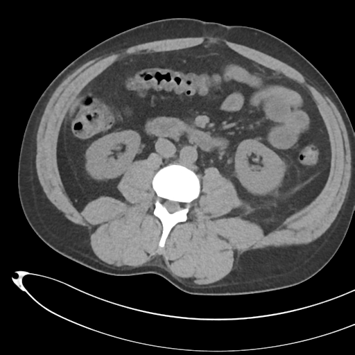 File:Necrotizing pancreatitis with acute necrotic collections (Radiopaedia 38829-41012 Axial non-contrast 43).png