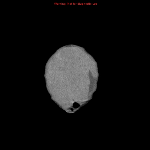 File:Neonatal neuroblastoma (Radiopaedia 9564-10223 B 10).jpg