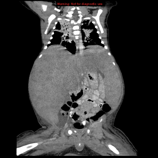 File:Neonatal neuroblastoma (Radiopaedia 9564-10223 B 77).jpg