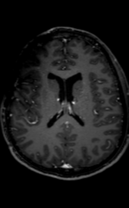 Neuro-Behçet disease (Radiopaedia 90112-107294 Axial T1 C+ 113).jpg