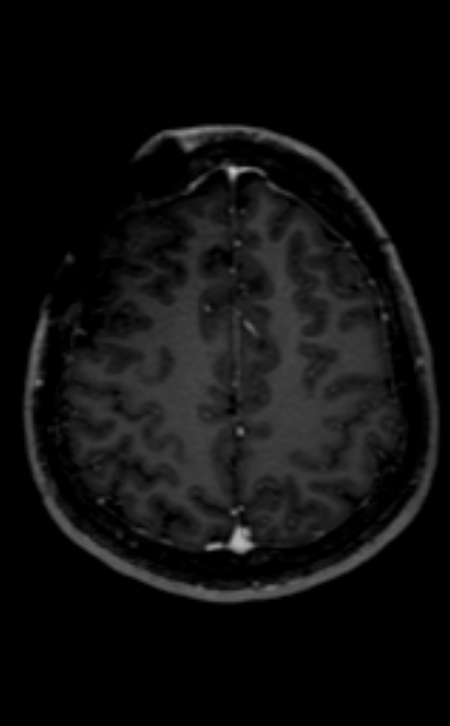 Neuro-Behçet disease (Radiopaedia 90112-107294 Axial T1 C+ 83).jpg