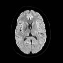 File:Neuro-Behcet's disease (Radiopaedia 21557-21506 Axial DWI 15).jpg