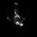 File:Neuro-Behcet's disease (Radiopaedia 21557-21506 Axial DWI 3).jpg
