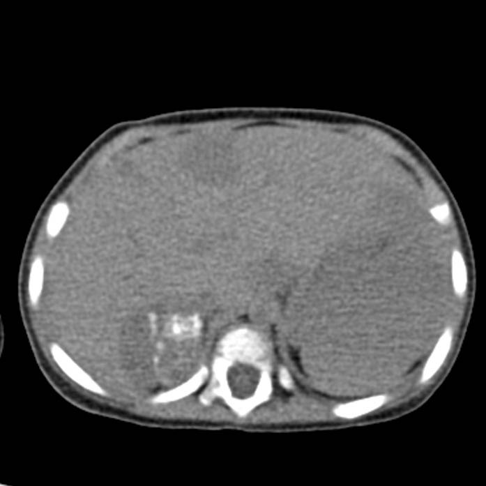 Neuroblastoma with skull metastases (Radiopaedia 30326-30960 Axial non-contrast 12).jpg