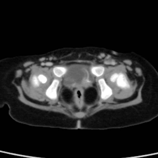Neuroblastoma with skull metastases (Radiopaedia 30326-30960 C 59).jpg