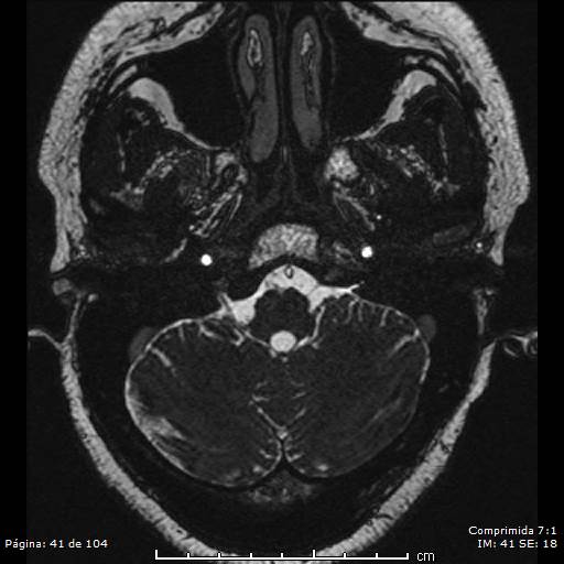 Neurocysticercosis (Radiopaedia 58636-65832 I 41).jpg