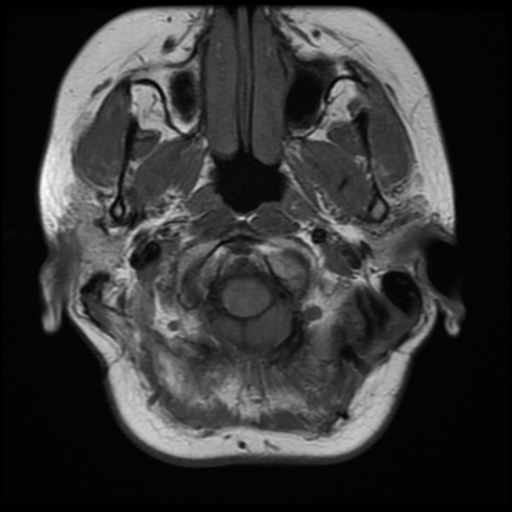File:Neurofibromatosis type 2 (Radiopaedia 45229-49251 Axial T1 5).png