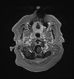 Neurofibromatosis type 2 (Radiopaedia 79097-92049 Axial T1 C+ 28).jpg
