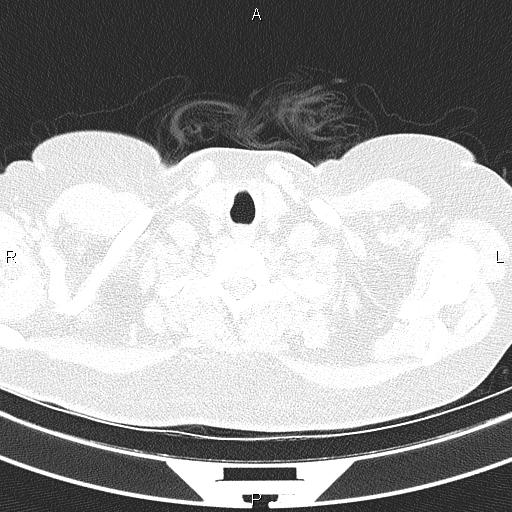 Non-specific interstitial pneumonia (Radiopaedia 83185-97567 Axial lung window 6).jpg