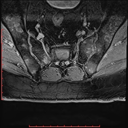 Non Hodgkin's lymphoma with metastasis to spine (Radiopaedia 54844-61103 Axial T1 C+ fat sat 32).jpg