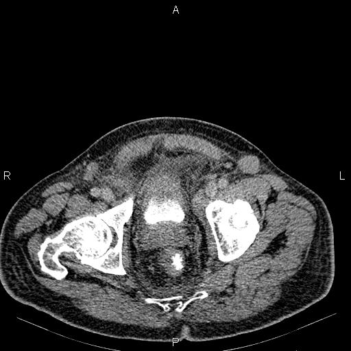 Non Hodgkin lymphoma in a patient with ankylosing spondylitis (Radiopaedia 84323-99621 Axial C+ delayed 76).jpg