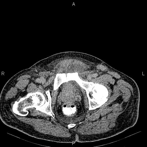 Non Hodgkin lymphoma in a patient with ankylosing spondylitis (Radiopaedia 84323-99621 Axial C+ delayed 79).jpg