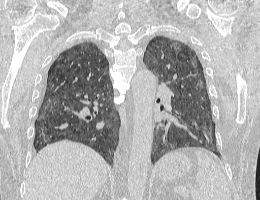 Non specific interstitial pneumonia (NSIP) (Radiopaedia 89725-106798 Coronal lung window 50).jpg