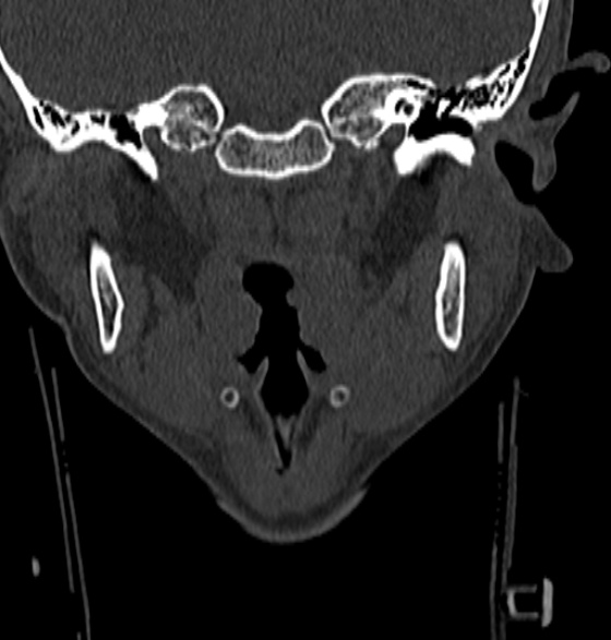 File:Normal CT cervical spine - 12-year-old (Radiopaedia 55352-61775 Coronal bone window 9).jpg