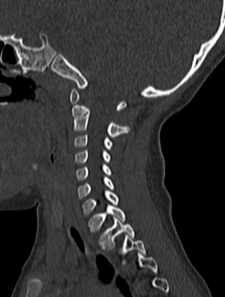 File:Normal CT cervical spine - pediatric (Radiopaedia 52549-58462 Sagittal bone window 139).jpg