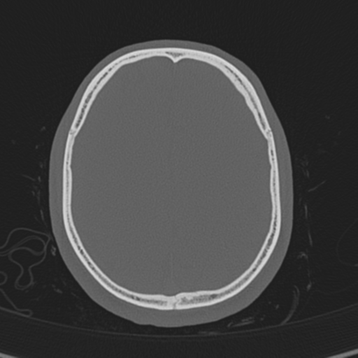 Normal CT skull (Radiopaedia 40798-43459 A 117).png