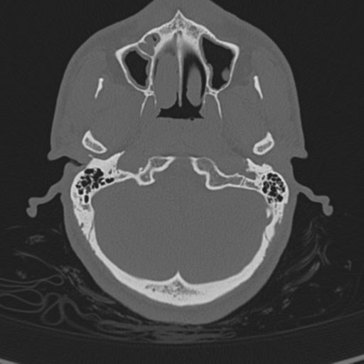 Normal CT skull (Radiopaedia 40798-43459 A 24).png