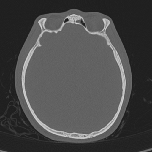 Normal CT skull (Radiopaedia 40798-43459 A 80).png