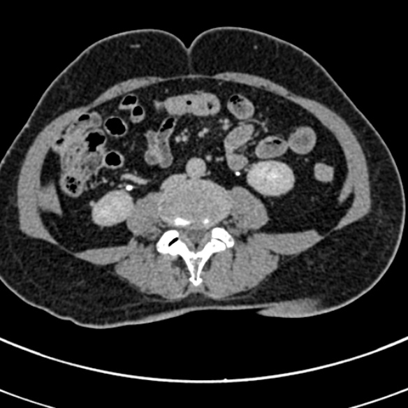 File:Normal CT split bolus study of the renal tract (Radiopaedia 48631-53634 Axial split bolus 149).jpg