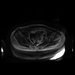 Normal MRI abdomen in pregnancy (Radiopaedia 88001-104541 Axial DWI 91).jpg