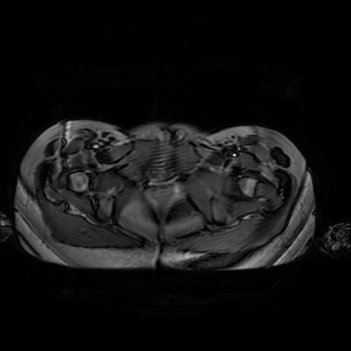 File:Normal MRI abdomen in pregnancy (Radiopaedia 88001-104541 Axial Gradient Echo 56).jpg