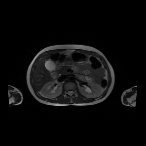File:Normal MRI abdomen in pregnancy (Radiopaedia 88001-104541 Axial T2 20).jpg