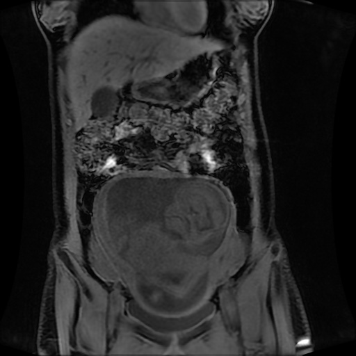 Normal MRI abdomen in pregnancy (Radiopaedia 88001-104541 M 50).jpg