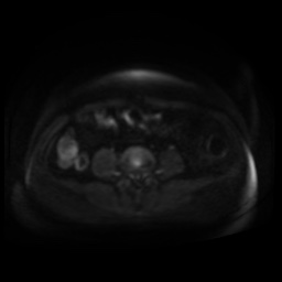 Normal MRI abdomen in pregnancy (Radiopaedia 88005-104548 Axial DWI 71).jpg