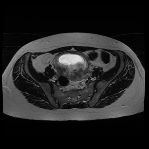 Normal MRI abdomen in pregnancy (Radiopaedia 88005-104548 Axial T2 22).jpg