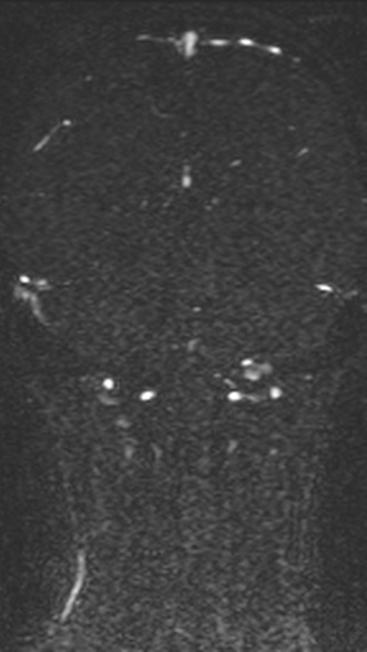 Normal MRI brain with MRV- teenager (Radiopaedia 49425-54553 Coronal MRV 170).jpg