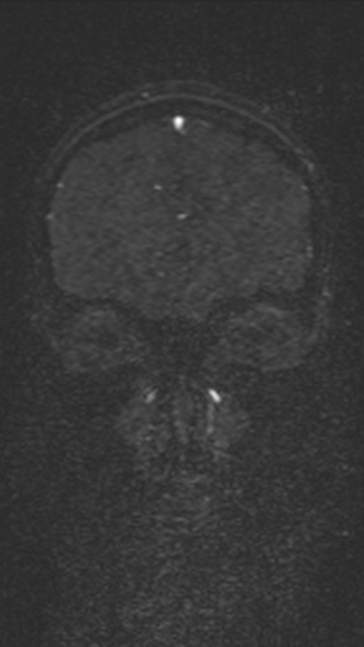 Normal MRI brain with MRV- teenager (Radiopaedia 49425-54553 Coronal MRV 57).jpg