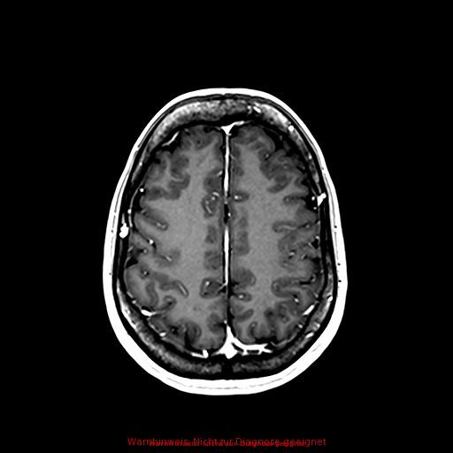 Normal adult brain MRI (non-enhanced and contrast-enhanced) (Radiopaedia 75262-86379 Axial T1 C+ 139).jpg