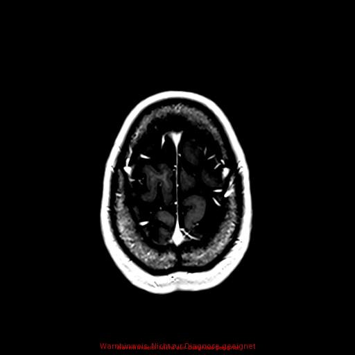 Normal adult brain MRI (non-enhanced and contrast-enhanced) (Radiopaedia 75262-86379 Axial T1 C+ 162).jpg