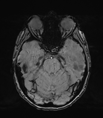 Normal brain MRI (TLE protocol) (Radiopaedia 40748-43405 Axial SWI 29).png