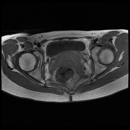 File:Normal female pelvis MRI (retroverted uterus) (Radiopaedia 61832-69933 Axial T1 21).jpg