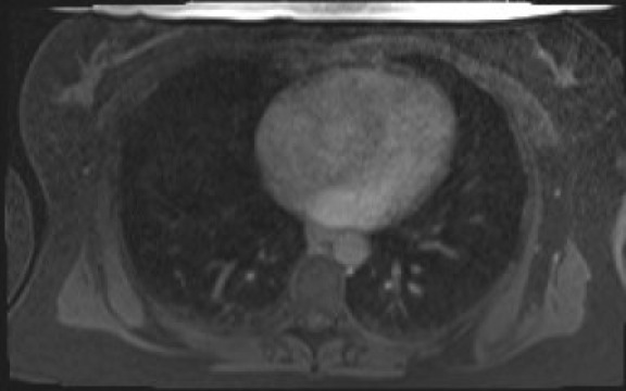 File:Normal hepatobiliary phase liver MRI (Radiopaedia 58968-66230 A 5).jpg