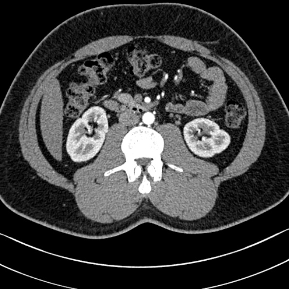 Normal kidneys on 4-phase CT study (Radiopaedia 25889-26038 B 55).jpg