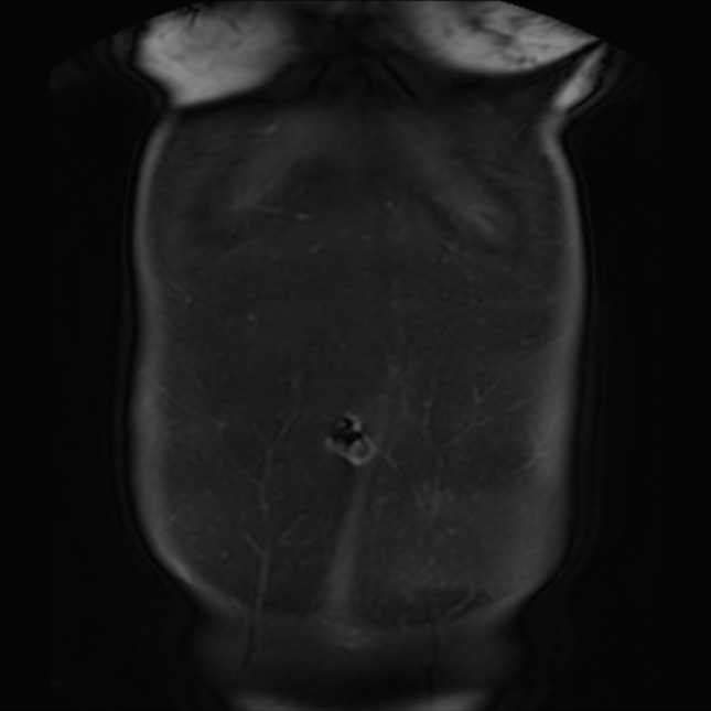 Normal liver MRI with Gadolinium (Radiopaedia 58913-66163 P 6).jpg
