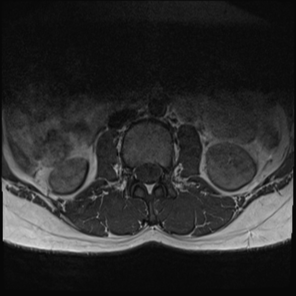 File:Normal lumbar spine MRI- 3 T (Radiopaedia 53280-59250 Axial 1).jpg
