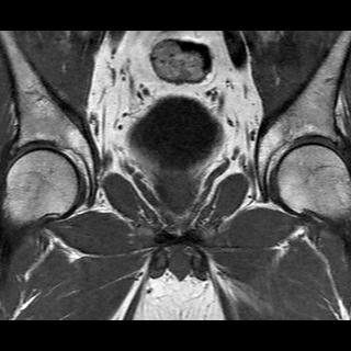 File:Normal prostate (MRI) (Radiopaedia 29986-30535 Coronal T1 8).jpg