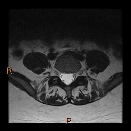 File:Normal spine MRI (Radiopaedia 77323-89408 Axial T2 21).jpg