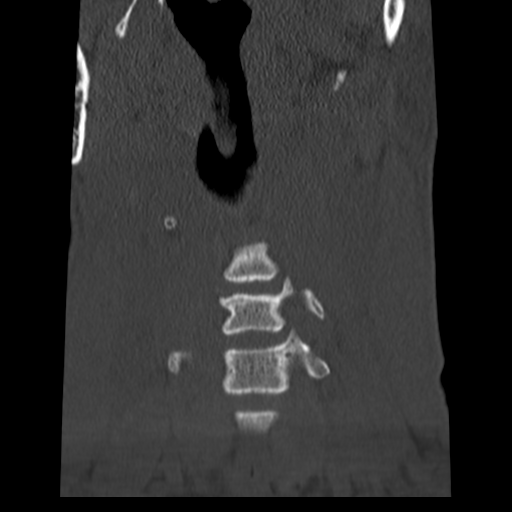 File:Normal trauma cervical spine (Radiopaedia 41017-43760 Coronal bone window 5).png