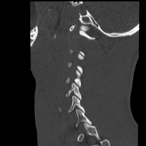 File:Normal trauma cervical spine (Radiopaedia 41017-43760 Sagittal bone window 39).png
