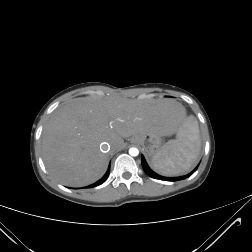 File:Nutmeg liver- Budd-Chiari syndrome (Radiopaedia 46234-50635 A 15).png