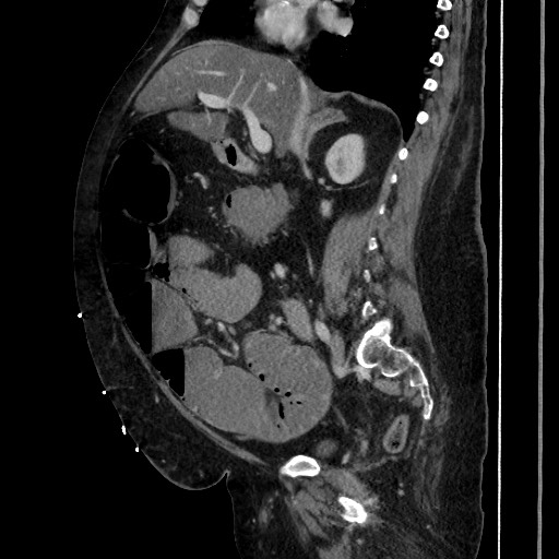 Obstructive colonic diverticular stricture (Radiopaedia 81085-94675 C 106).jpg