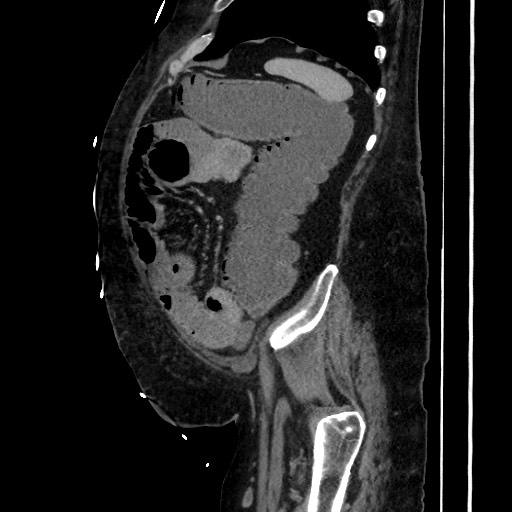 Obstructive colonic diverticular stricture (Radiopaedia 81085-94675 C 186).jpg