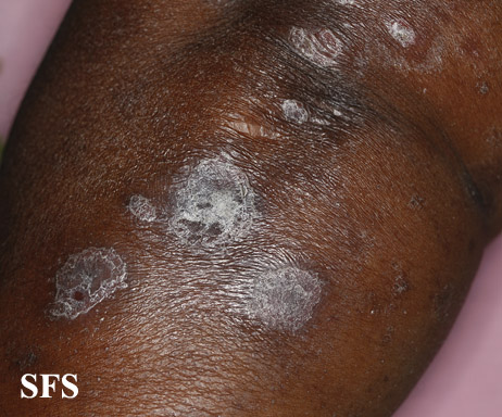 File:Psoriasis (Dermatology Atlas 48).jpg