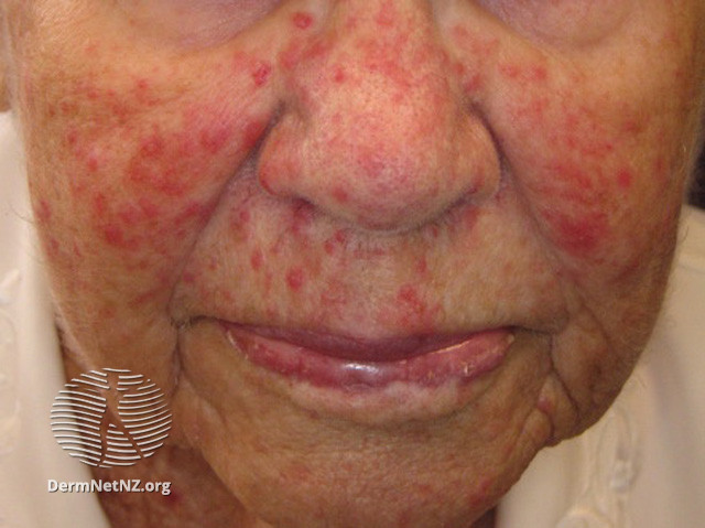 Rosacea (DermNet NZ acne-red-face-3627).jpg